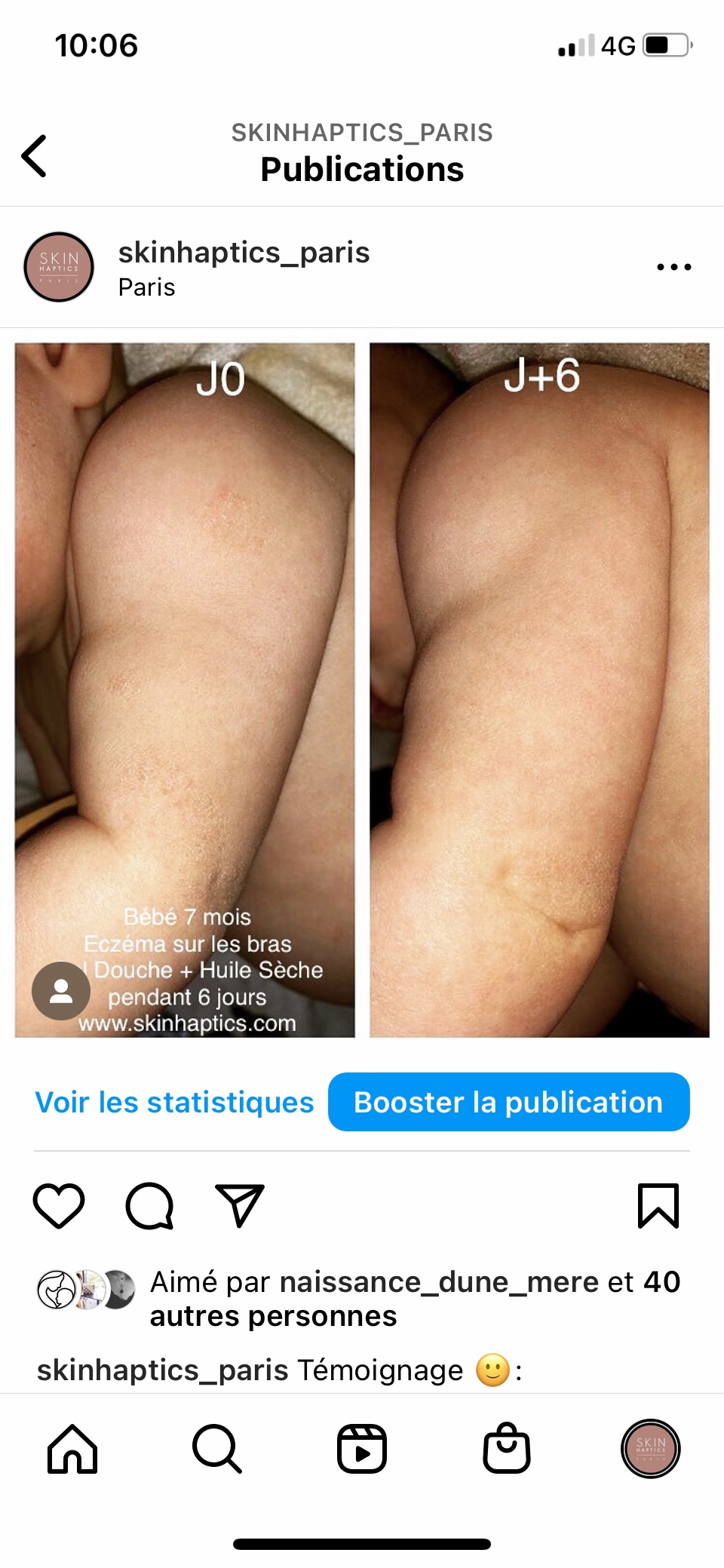 Avant-après Gel douche + huile sèche skinhaptics sur peau atopique bébé