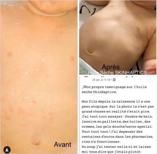 nouveau né peau atopique avant après