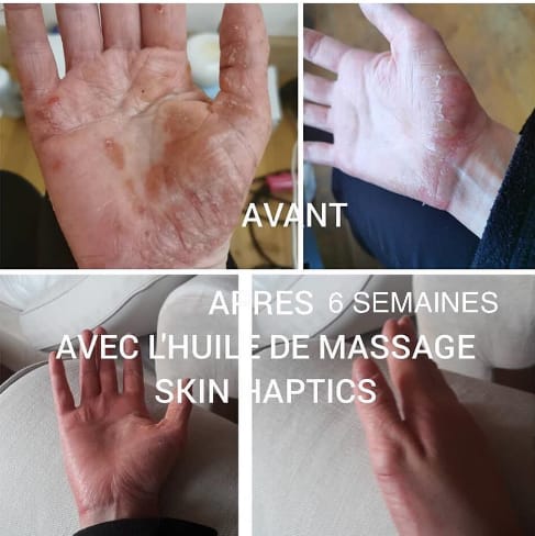peau atopique avant apres 6 semaines avec l'huile de massage skinhaptics